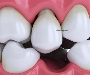 dente-mole-dentes-moles-o-que-causa Eventuais motivos de reclamação em tratamento com implante dentário