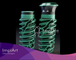 implante-straumann-iexcel-2 Clínica de Implante Dentário e Prótese Dentária ImplArt