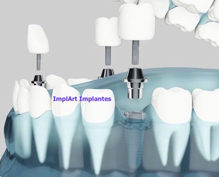 implante-de-tres-dentes-separados Implante de Três Dentes Juntos - Como fazer ?