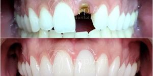 implante_unitario_coroa_metal_free_antes_e_depois_50kb Dentes de tubarão: imagens divulgadas na internet como lentes dentais, mas não são.