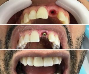 implante_dentario_unitario_50kb Irrigador dental é um aliado da boa higiene oral para implantes