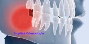 nico-lesao-cavitacional-no-osso-4 Carga imediata: qual a diferença para um tratamento normal