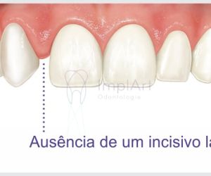 agenesia_dental Epilepsia e a Odontologia: tratamento dental e implante dentário