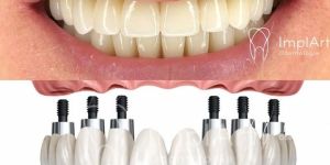 all-on-6 Depois de um tratamento de canal deve-se fazer restauração ou núcleo e coroa de porcelana?