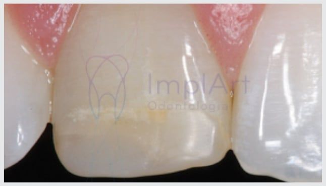 resina_manchada Restaurações de resina podem se arranhar com pasta de dente