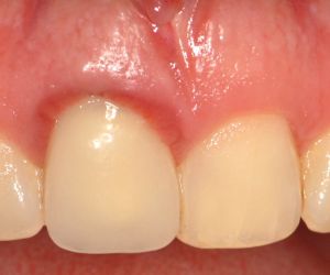 dente_inflamado Restaurando Sorrisos com Precisão: Implante Dentário Parcial na Clínica ImplArt