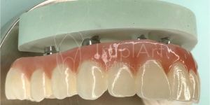 protese_zirconia_pura_50kb Tratamento para bolsa periodontal