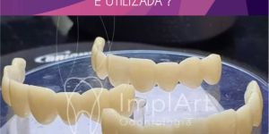 PROTESES-PROVISORIAS-COMO-E-PORQUE-E-UTIIZADA Implante dentário com carga imediata: indicações e contra indicações