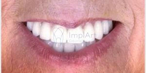 reabilitacao_oral_protese_fixa_implante_zirconia_30kb Complicações / erros e falhas em implantes dentários