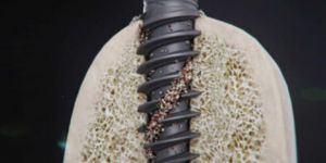 osseointegracao_de_implantes_49kb Vídeo: cirurgia de implante dentário