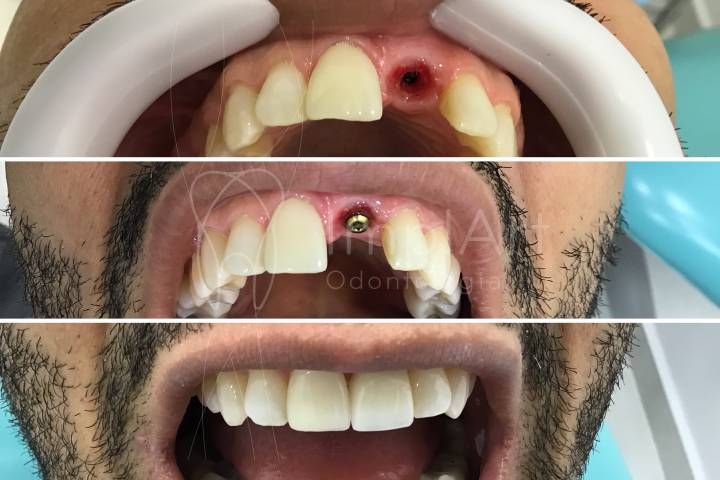 implante_dentario_unitario_50kb Implantes dentários no mesmo dia da extração