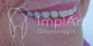 carga_imediata_implante_total_48kb Quantos implantes dentários são colocados de cada vez?