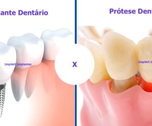 implante-ou-protese-dentaria-qual-e-melhor Implante de Três Dentes Juntos - Como fazer ?