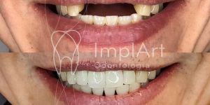 Implante_dentario_de_4_dentes_na_frente_50kb A importância da manutenção do aparelho ortodôntico