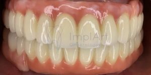 protese_metaloceramica_total_superior_50kb Implantes dentários no mesmo dia da extração