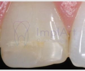 resina_manchada All on 4 Implants in Brazil: affordable Smiles
