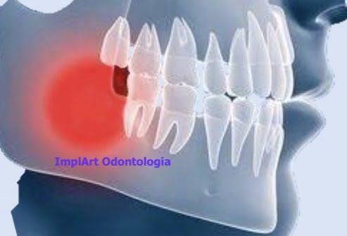 nico-lesao-cavitacional-no-osso-4 O que é Mewing?