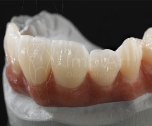 coroa_zirconia_multilayer_50kb Restaurando Sorrisos com Precisão: Implante Dentário Parcial na Clínica ImplArt