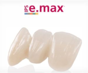 coroas_ceramica_emax_50kb Enxerto ósseo biomolecular para implante