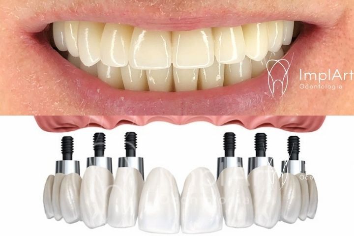 all-on-6 Implantes All on 6: Solução Completa para o Sorriso com implantes