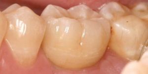 implantes-nos-dentes-do-fundo-4-vista-lateral Infecção nos dentes pode causar doenças no coração