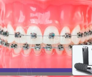 aparelho_ortodontico_implante_50kb Dentaduras modernas: cuidados e novas técnicas