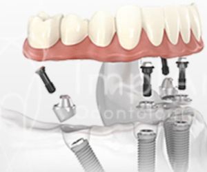 Carga_imediata_All_on_4_50kb Sedação odontológica: tratamento dentário para odontofobia