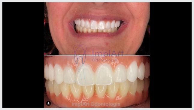 Reabilitacao_oral_total_superior_e_inferior_em_zirconia_translucida_40kb O que é enxerto ósseo dentário