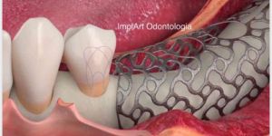 tela_titanio_para_enxerto_40kb Implante de Três Dentes Juntos - Como fazer ?