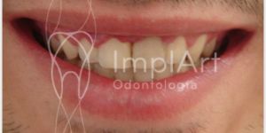 gengivite_41kb Carga imediata - Implante dentário mais rápido