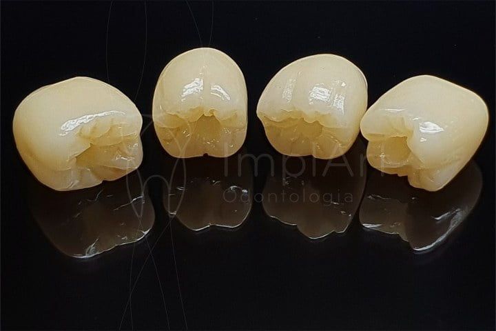 coroas_zirconia_zolid_50kb Qual a diferença entre pivô, coroa e jaqueta?