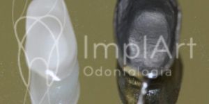 nucleo_estetico_x_metalico_49kb Implantes Dentários: solução para boca amarga