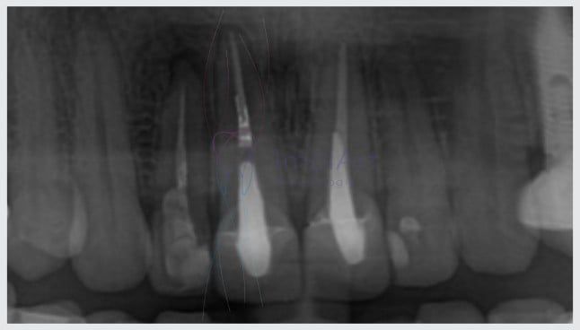 tratamento_de_canal_27kb Retratamento de canal: o que é e para que serve