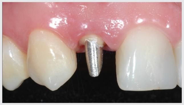 nucleo_metalico_30kb Núcleo estético de fibra evita o uso de metal