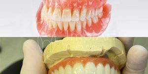 protese_movel_dentadura_x_protese_implante_50kb Cirurgia de implante guiada (fechada) ou cirurgia aberta