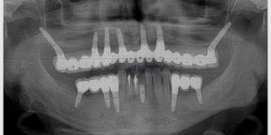 implante_zigomatico_45kb Enxerto ósseo biomolecular para implante