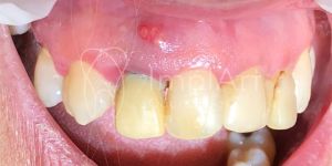 fistula_dental_49kb Restaurações metálicas: quando substituir por porcelana ou resina?