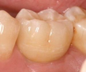 implantes-nos-dentes-do-fundo-4-vista-lateral Rejeição de implante dentário: pode ocorrer?