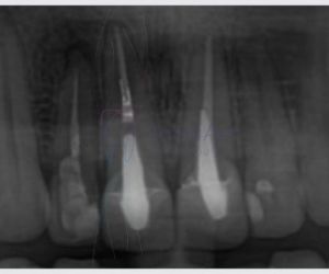 tratamento_de_canal_27kb Extração de dente: indicações e cuidados