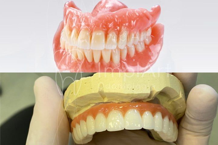 protese_movel_dentadura_x_protese_implante_50kb Não confunda implante com prótese convencional