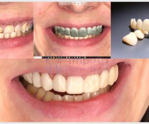 test_drive_do_sorriso_50kb Extração de dente: indicações e cuidados