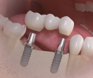 ponte_fixa_sobre_implantes_50kb Prótese protocolo de resina com estrutura de titânio