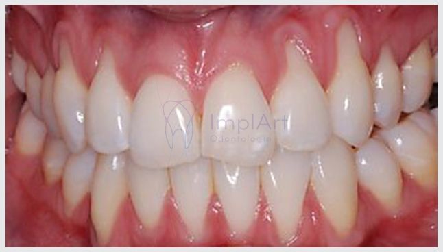 retracao_gengival_25kb Retração gengival é reversível?