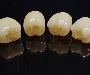 coroas_zirconia_zolid_50kb Restaurando Sorrisos com Precisão: Implante Dentário Parcial na Clínica ImplArt