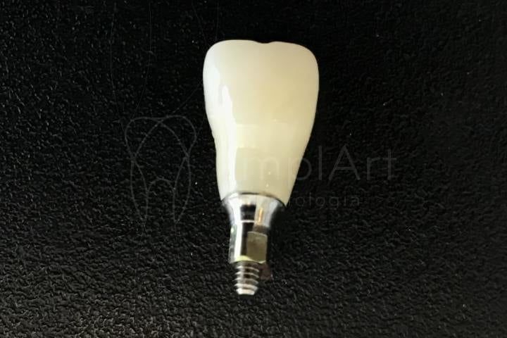 coroa_aparafusada Coroa dentária em um dia para restaurar dentes rápido