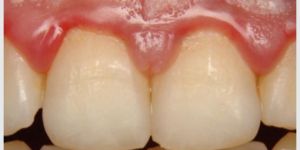 bolsa_periodontal_25kb Dúvidas sobre prótese dentária protocolo sob implante dental