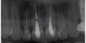 tratamento_de_canal_27kb Cirurgia de implante guiada (fechada) ou cirurgia aberta