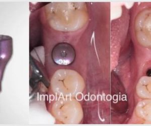 implante_caiu_40kb Diastema dentário deixa o sorriso feio?