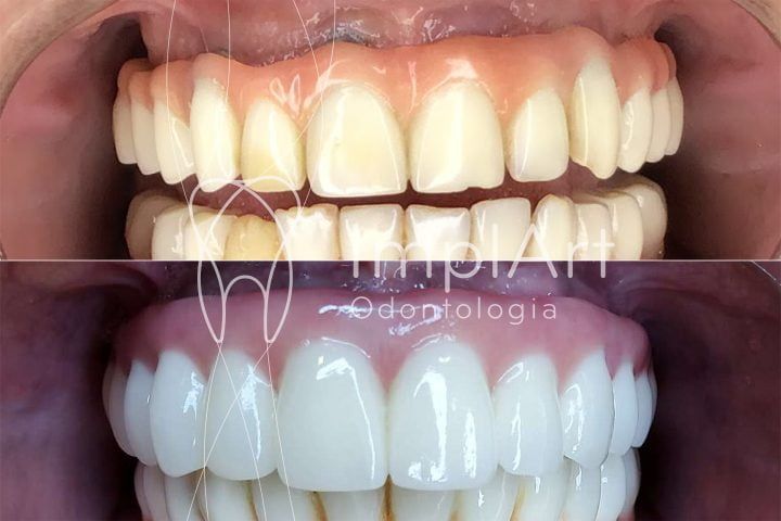 protese_total_fixa_em_zirconia_implante_antes_e_depois_50kb Troque a prótese protocolo de resina por prótese de porcelana ou zircônia