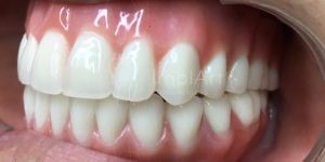 protese_total_resina_protocolo_implante_50kb Agenesia: dentes que não nasceram podem ser supridos com implantes?